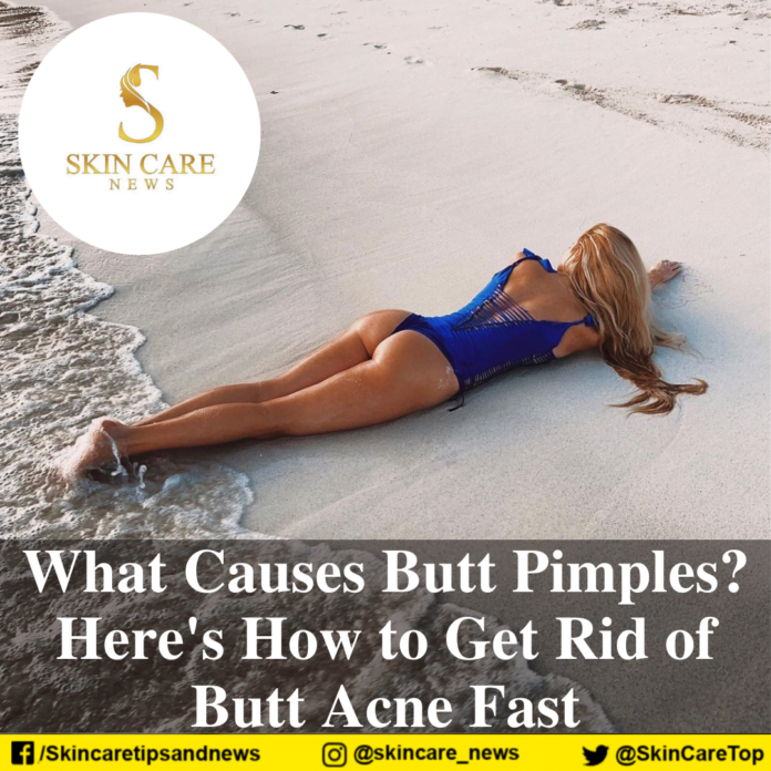 What Causes Butt Pimples? Here's How to Get Rid of Butt Acne Fast