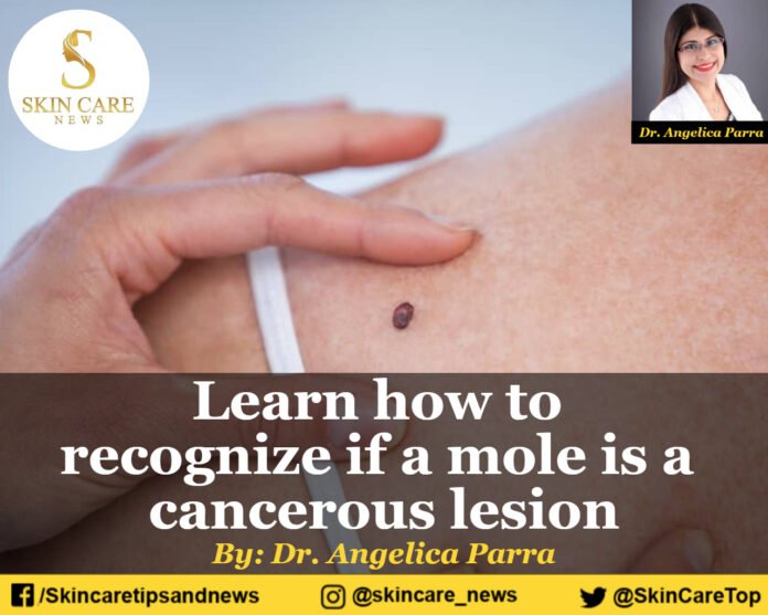 Learn how to recognize if a mole is a cancerous lesion