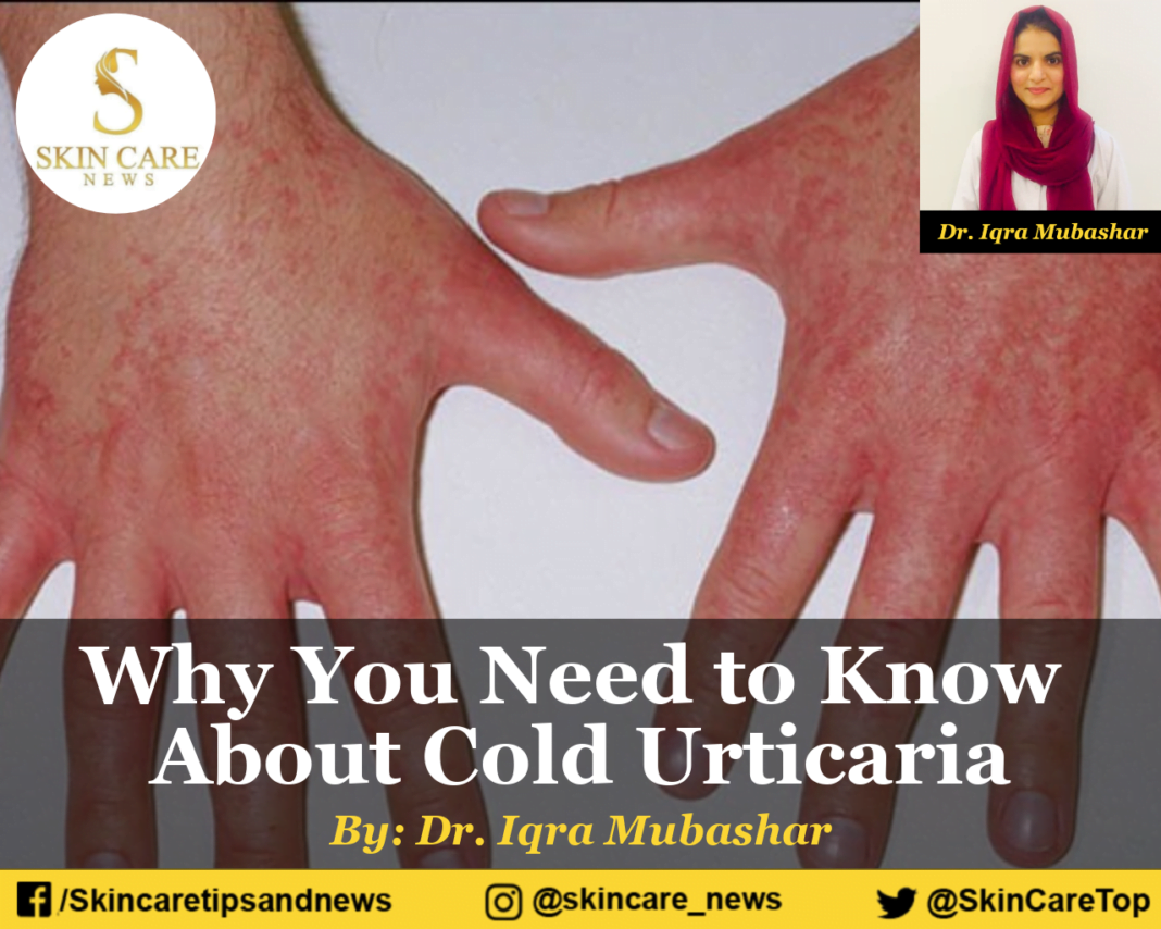 Why You Need to Know About Cold Urticaria