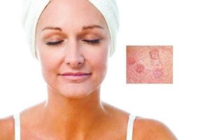 What Is Sebaceous Hyperplasia?