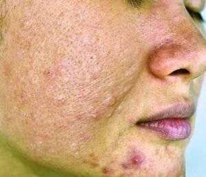 What Is Sebaceous Hyperplasia?