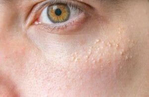In newborn babies, milia are resolved within a matter of a few days or weeks. However, if they persist, you should see a doctor. Make sure you don't apply any product on the baby's skin to treat milia without consulting the doctor.
