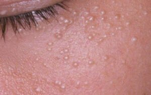What Are These Tiny White Bumps On Your Skin?