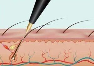 What Is Electrolysis Technique for Hair Removal?
