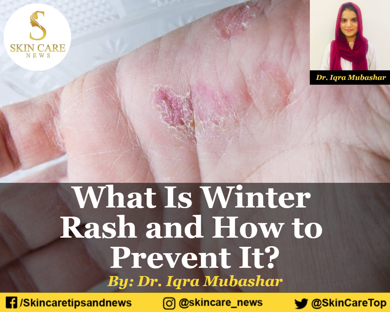 what-is-winter-rash-and-how-to-prevent-it