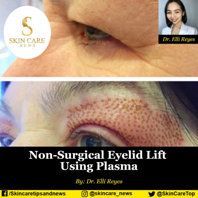 Non-Surgical Eyelid Lift Using Plasma