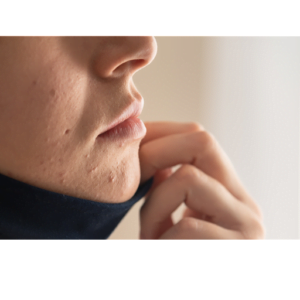 Simple Tips on How to Avoid Mask Acne