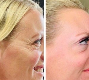 How to Deal with Crow's Feet?