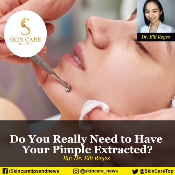 Do You Really Need to Have Your Pimple Extracted?