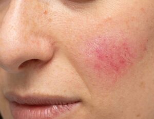 Azelaic Acid: An Effective Ingredient for Rosacea and Acne Scars