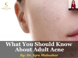 What You Should Know About Adult Acne