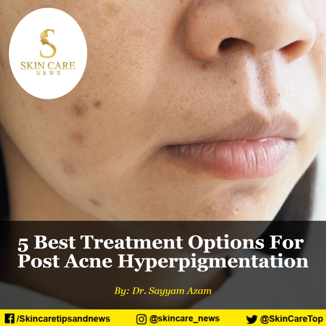 5 Best Treatment Options For Post Acne Hyperpigmentation
