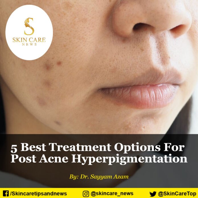 5 Best Treatment Options For Post Acne Hyperpigmentation