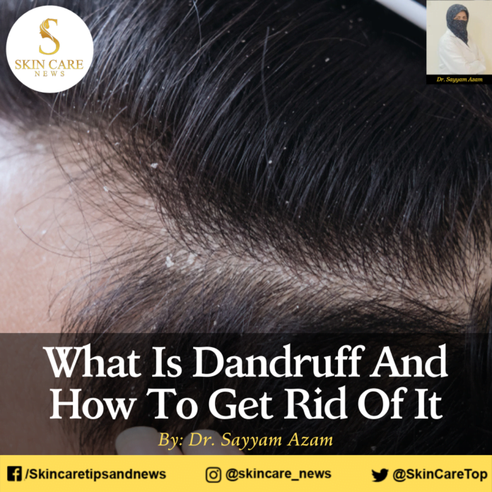 What Is Dandruff And How To Get Rid Of It
