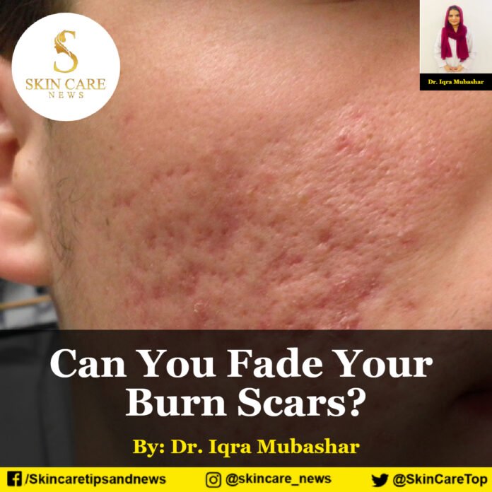 Can You Fade Your Burn Scars?