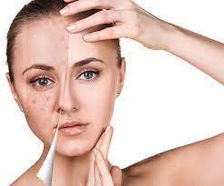 Skincare Routine For Acne-Prone Skin