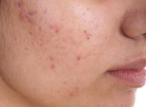 Benzoic Acid: A Treatment For Acne