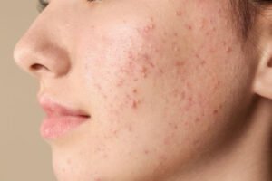 Skincare Routine For Acne-Prone Skin