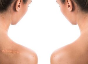Can You Fade Your Burn Scars?