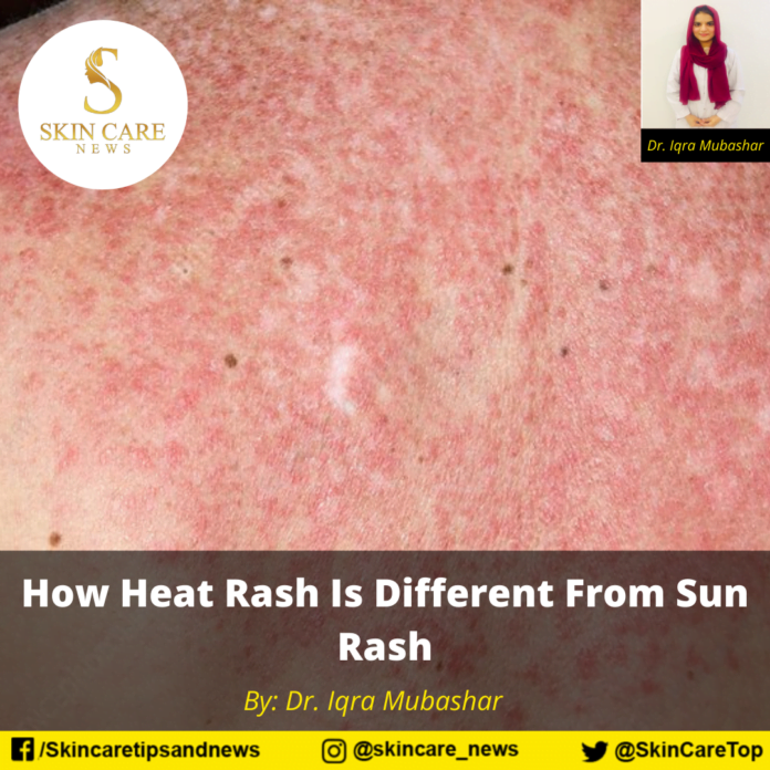 How Heat Rash Is Different From Sun Rash