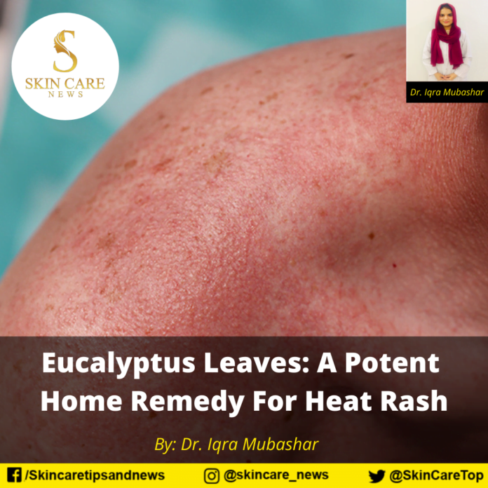 Eucalyptus Leaves A Potent Home Remedy For Heat Rash