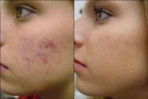6 Miraculous Benefits Of Niacinamide