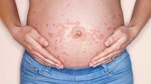 Heat Rash During Pregnancy – Risks And Treatments