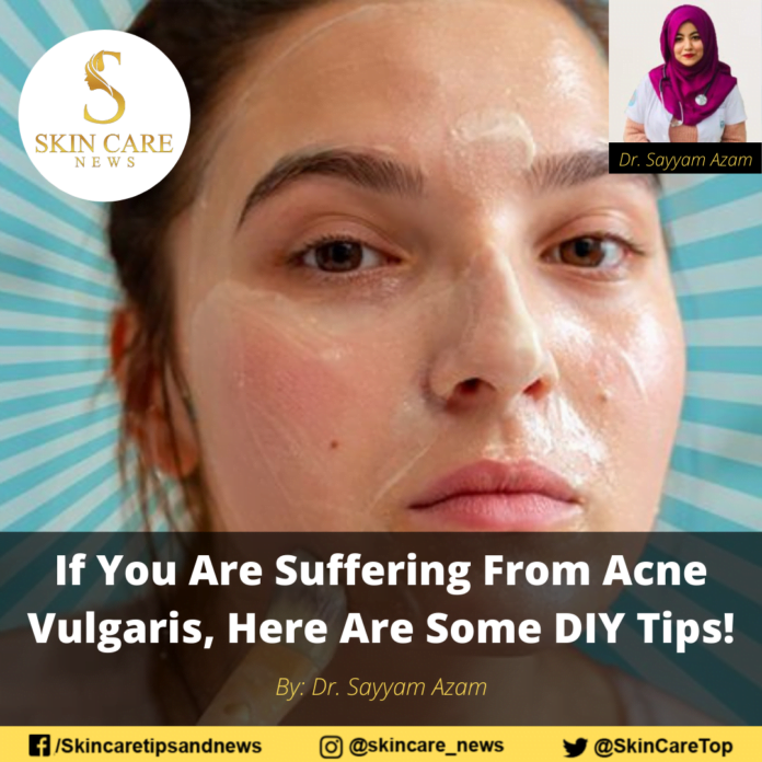 If You Are Suffering From Acne Vulgaris, Here Are Some DIY Tips!
