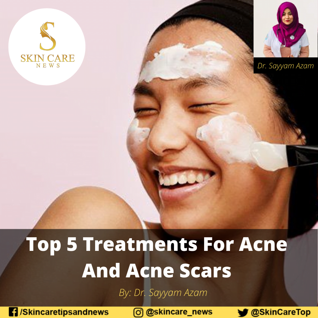 top-5-treatments-for-acne-and-acne-scars