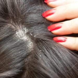  Tea tree oil: In our previous articles, we have explained the wondrous effects of tea tree oil on both our skin and hair. It has strong antifungal and antiseptic properties that will prevent your scalp from all symptoms of dry scalp.  How to use it? You can use it by mixing it with other oils like olive oil or coconut oil in equal proportions. Apply the mixture of oil to your scalp and massage for five minutes. Let it stay for 10 minutes and then wash your hair with shampoo. Repeat this twice a week to get the most effective results. 