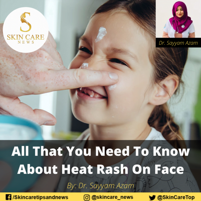 All That You Need To Know About Heat Rash On Face
