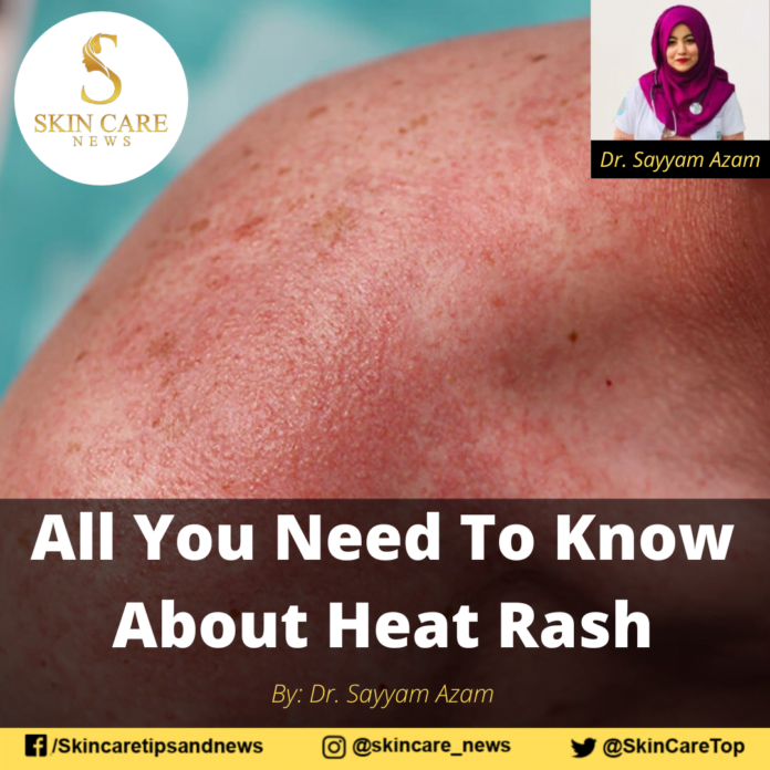 All You Need To Know About Heat Rash