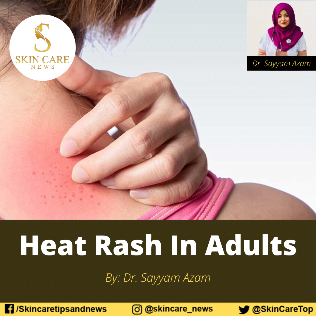 heat-rash-in-adults