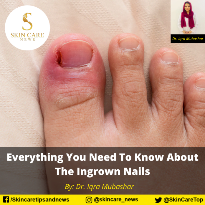 Everything You Need To Know About The Ingrown Nails