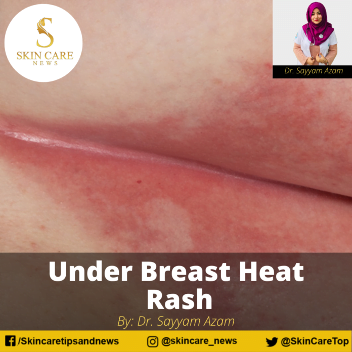Under Breast Heat Rash