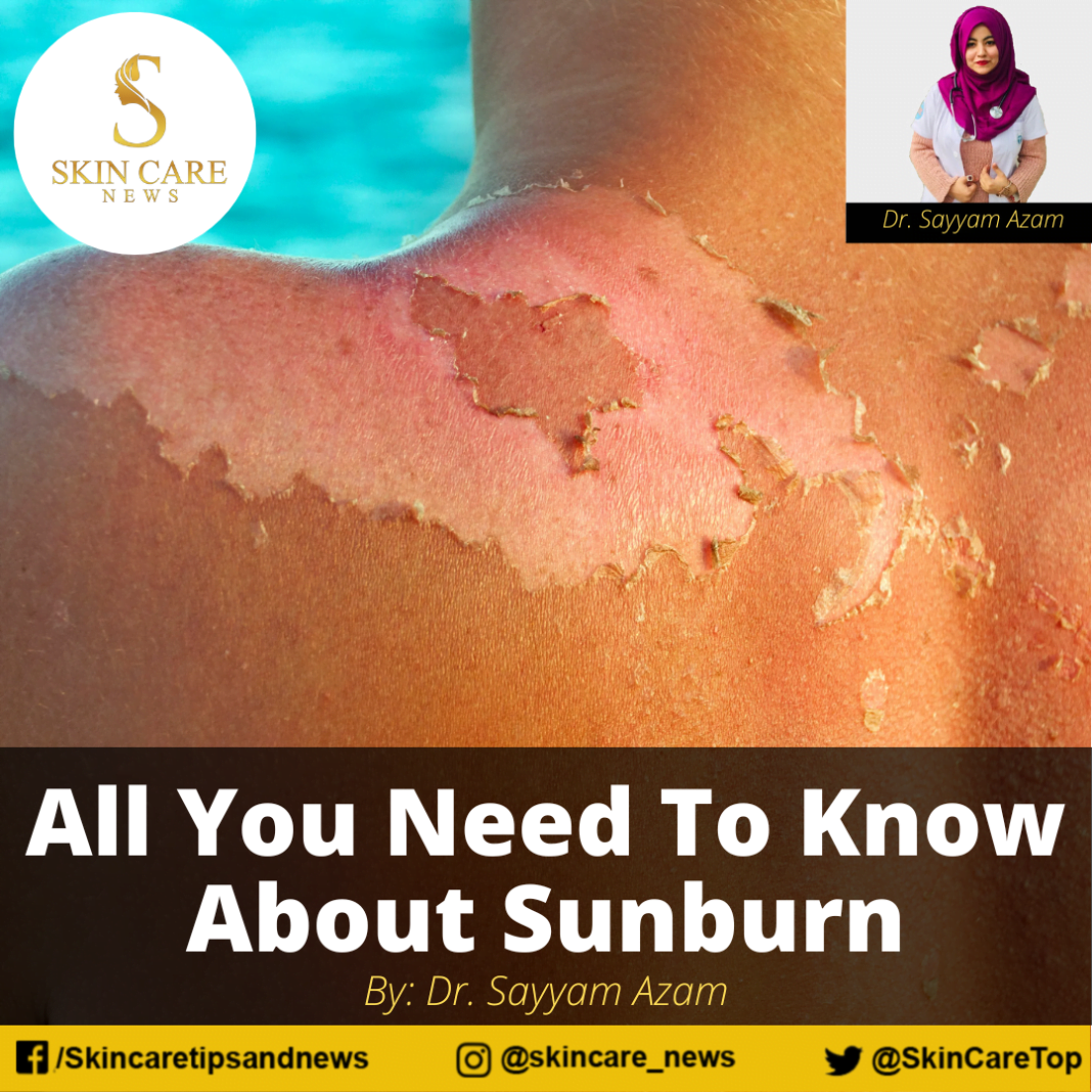 All You Need To Know About Sunburn