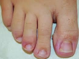 Everything You Need To Know About The Ingrown Nails