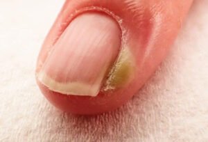 Everything You Need To Know About The Ingrown Nails