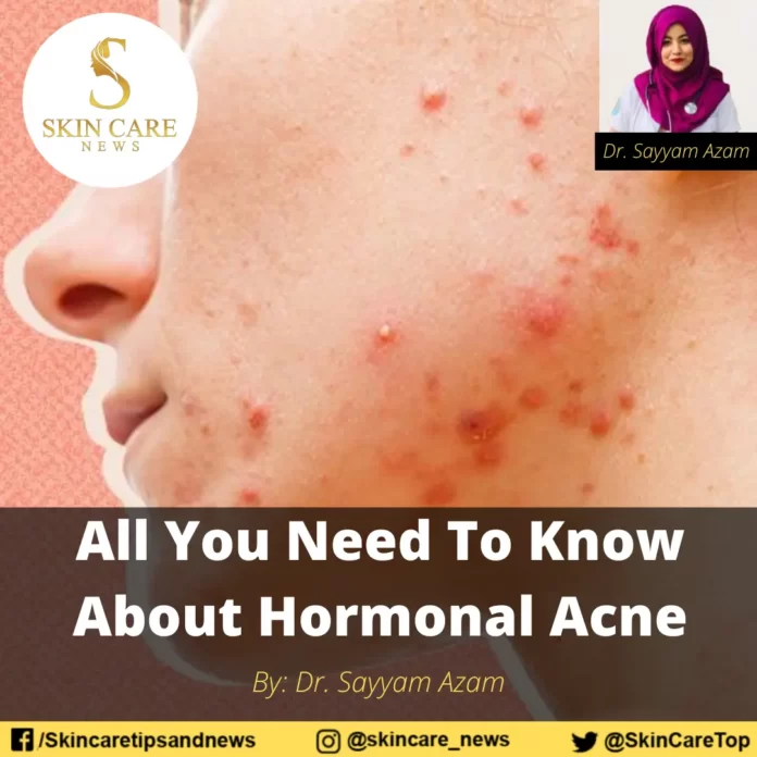 All You Need To Know About Hormonal Acne