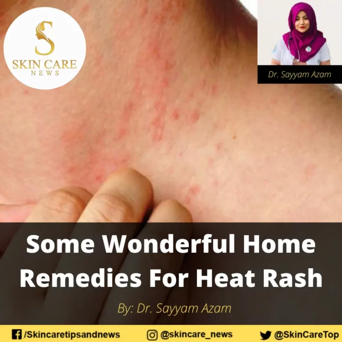 Some Wonderful Home Remedies For Heat Rash