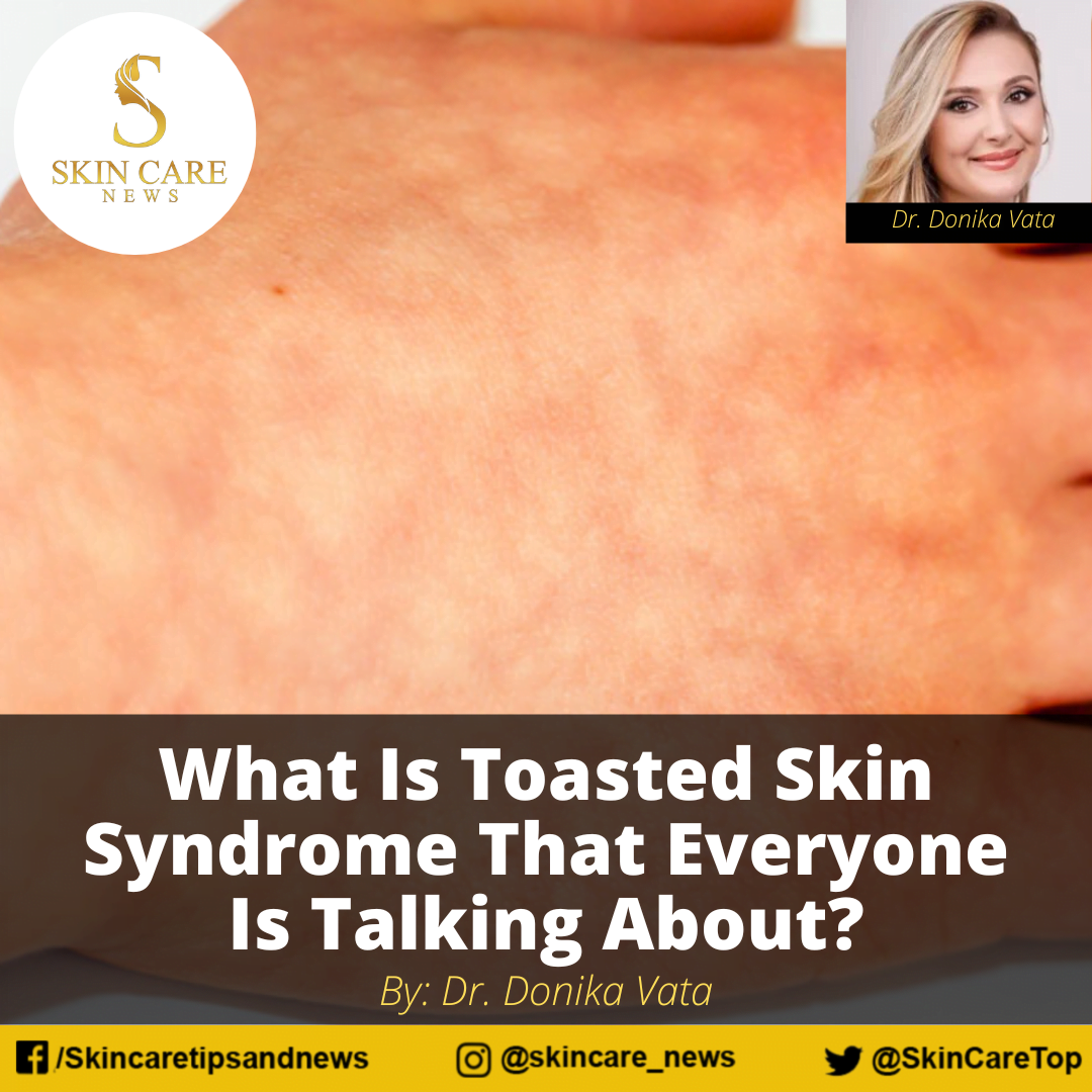 what-is-toasted-skin-syndrome-that-everyone-is-talking-about