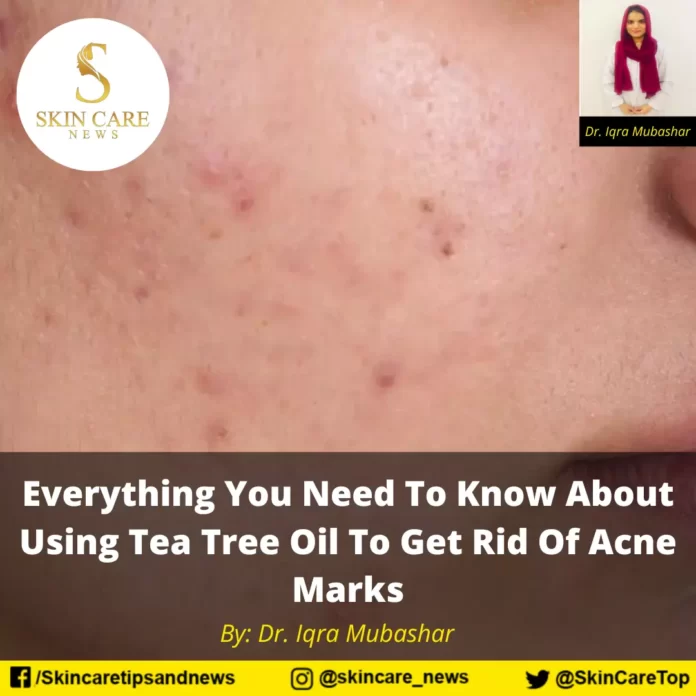 Everything You Need To Know About Using Tea Tree Oil To Get Rid Of Acne Marks