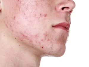  Acne Marks