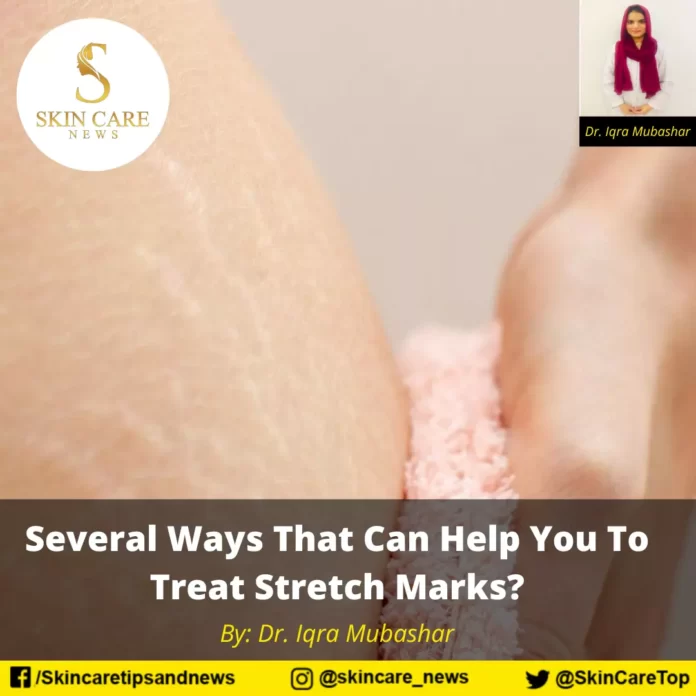 Several Ways That Can Help You To Treat Stretch Marks?