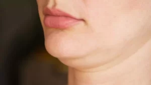 Double Chin