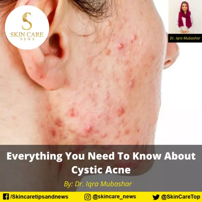 Everything You Need To Know About Cystic Acne