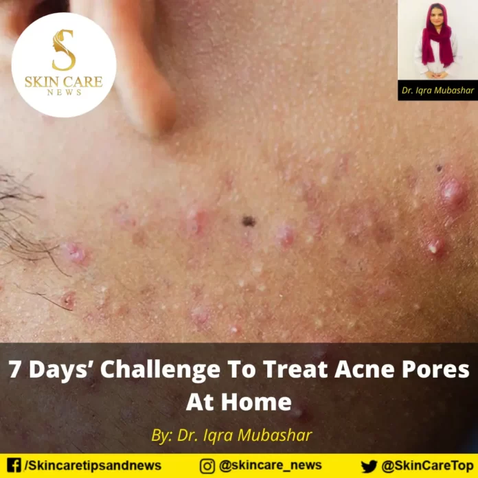 7 Days’ Challenge To Treat Acne Pores At Home