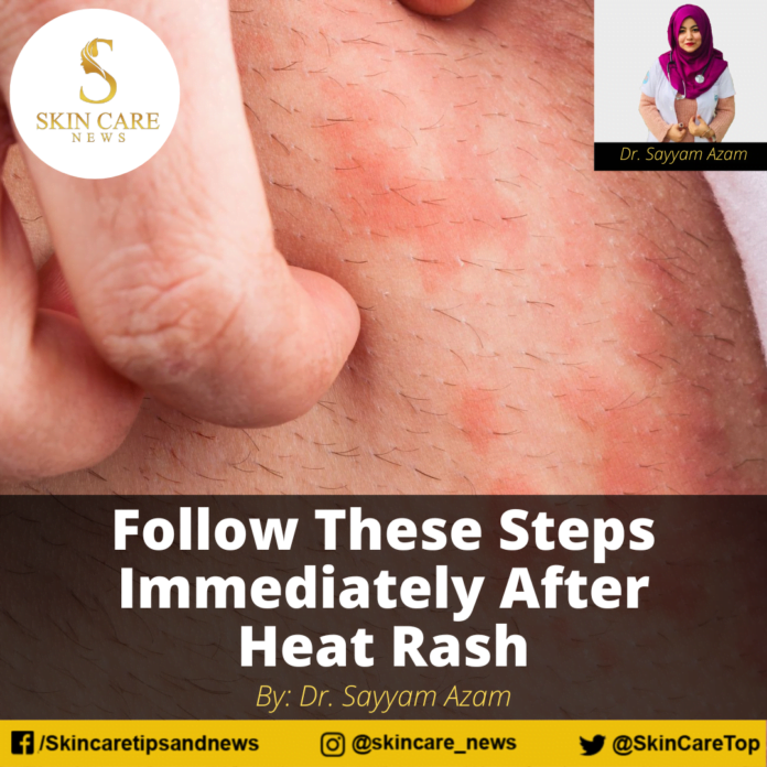 Follow These Steps Immediately After Heat Rash