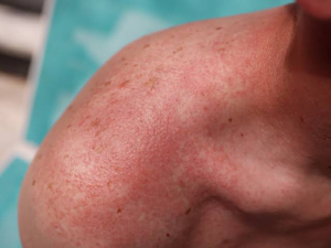 Some Wonderful Home Remedies For Heat Rash