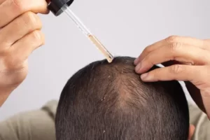 Minoxidil And How To Properly Use